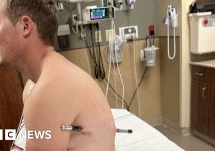 Man impaled by a hiking pole treks 10 miles down mountain