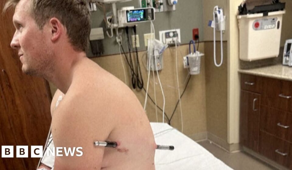 Man impaled by a hiking pole treks 10 miles down mountain