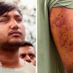 CJP protest: India's 'Cockroach' protesters have wounds consistent with pellet-gun fire, experts say