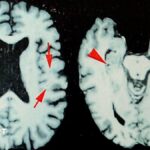 NFL: At least one in four dead players had brain disease, says study
