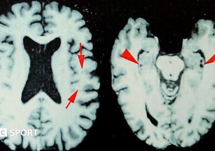 NFL: At least one in four dead players had brain disease, says study