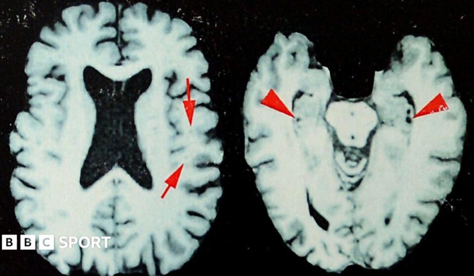 NFL: At least one in four dead players had brain disease, says study