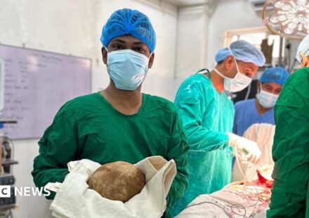 Sri Lanka: Doctors remove 3.1kg stone from man's bladder