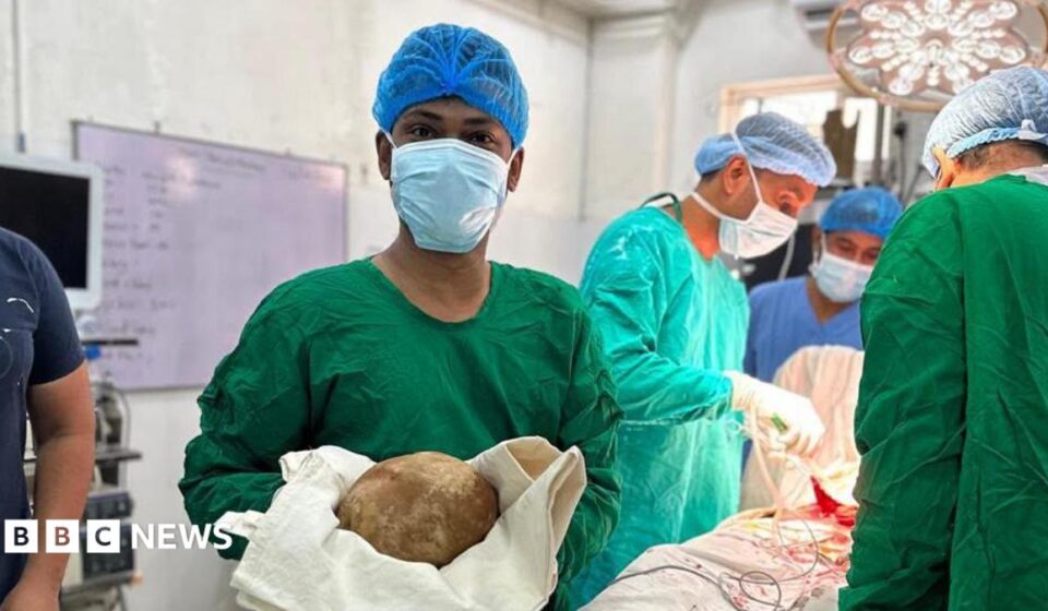 Sri Lanka: Doctors remove 3.1kg stone from man's bladder